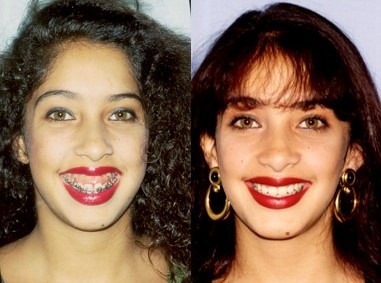 Before and after of a patient's gummy smile / vertical excess - Dr. Cesar Guerrero - Houston, TX